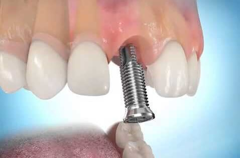 ön diş implant